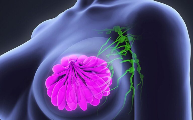 Mulheres na pós-menopausa com câncer de mama podem evitar quimioterapia