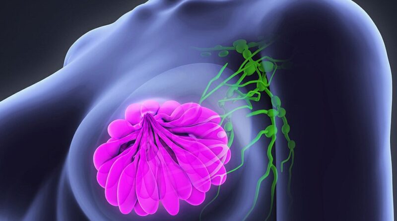 Mulheres na pós-menopausa com câncer de mama podem evitar quimioterapia
