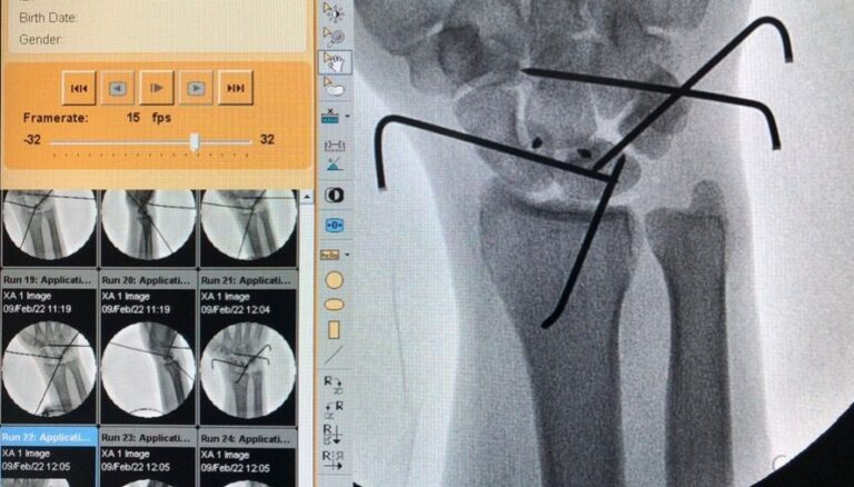 Ligamentoplastia inédita é realizada com sucesso pelo Hospital Estadual de Formosa