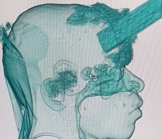 Médicos da Medplus Serviços Médicos no Hospital Municipalizado Adão Pereira Nunes realizaram uma cranioplastia no carpinteiro, Vitor Soares.