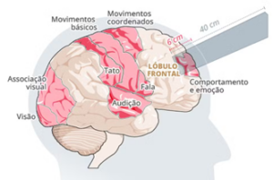 Médicos da Medplus Serviços Médicos no Hospital Municipalizado Adão Pereira Nunes realizaram uma cranioplastia no carpinteiro, Vitor Soares.